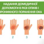 Презентація “Надання домедичної допомоги в разі опіків і проникного поранення ока”